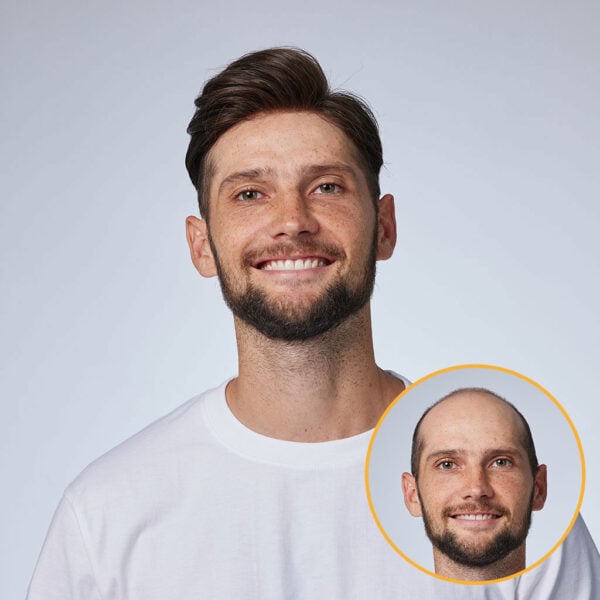 HS1V : V-Loop Men's Hair System 0.06 mm Poly Thin Skin